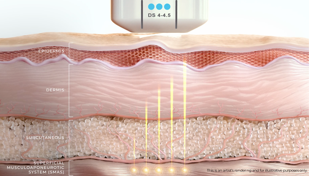 Il lifting non invasivo Ultherapy Prime agisce in profondità
